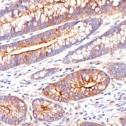 Formalin-fixed, paraffin-embedded human Colon Carcinoma stained with CEA Monoclonal Antibody (SPM551)