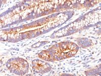 Formalin-fixed, paraffin-embedded human Colon Carcinoma stained with CEA Monoclonal Antibody (SPM551)