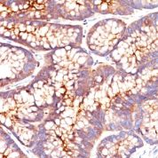 Formalin-fixed, paraffin-embedded human Colon Carcinoma stained with CEA Monoclonal Antibody (CEA31)