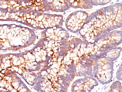 Formalin-fixed, paraffin-embedded human Colon Carcinoma stained with CEA Monoclonal Antibody (CEA31)