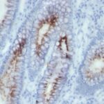 Formalin-fixed, paraffin-embedded human Colon Carcinoma stained with CEA Monoclonal Antibody (SPM56)