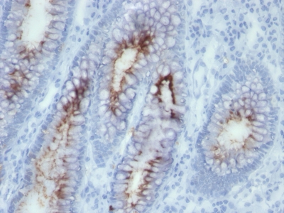 Formalin-fixed, paraffin-embedded human Colon Carcinoma stained with CEA Monoclonal Antibody (SPM56)