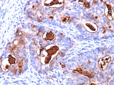 Formalin-fixed, paraffin-embedded human Colon Carcinoma stained with CEA Monoclonal Antibody (COL-1+CEA31+C66/261)