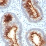 Formalin-fixed, paraffin-embedded human Colon Carcinoma stained with CEA Monoclonal Antibody (C66/13)