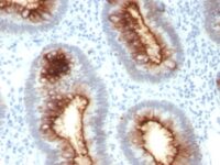 Formalin-fixed, paraffin-embedded human Colon Carcinoma stained with CEA Monoclonal Antibody (C66/13)