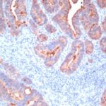 Formalin-fixed, paraffin-embedded human Colon Carcinoma stained with CEA, pan Monoclonal Antibody (C66/195+C66/261+ C66/19+ C66/13)