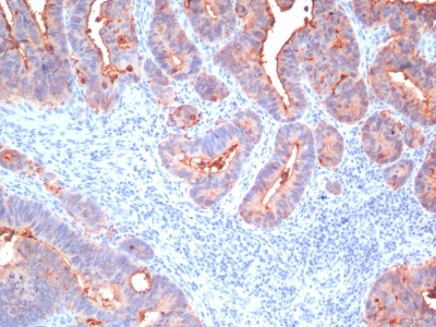 Formalin-fixed, paraffin-embedded human Colon Carcinoma stained with CEA, pan Monoclonal Antibody (C66/195+C66/261+ C66/19+ C66/13)