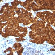 Formalin-fixed, paraffin-embedded Pancreas stained with Chromogranin A Monoclonal Antibody (CGA/413+ CHGA/777+ CHGA/798)