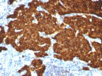 Formalin-fixed, paraffin-embedded Pancreas stained with Chromogranin A Monoclonal Antibody (CGA/413+ CHGA/777+ CHGA/798)