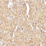 Formalin-fixed, paraffin-embedded human Small Cell Lung Carcinoma stained with Chromogranin A Monoclonal Antibody (LK2H1)