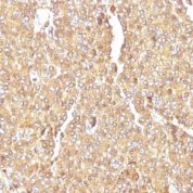 Formalin-fixed, paraffin-embedded human Small Cell Lung Carcinoma stained with Chromogranin A Monoclonal Antibody (LK2H1)