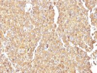 Formalin-fixed, paraffin-embedded human Small Cell Lung Carcinoma stained with Chromogranin A Monoclonal Antibody (LK2H1)