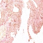 Formalin-fixed, paraffin-embedded human Small Cell Lung Carcinoma stained with Chromogranin A Monoclonal Antibody (SPM339)