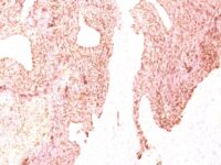 Formalin-fixed, paraffin-embedded human Small Cell Lung Carcinoma stained with Chromogranin A Monoclonal Antibody (SPM339)