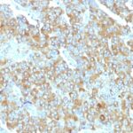 Formalin-fixed, paraffin-embedded human Small Cell Lung Carcinoma stained with Chromogranin A Monoclonal Antibody (PHE5)