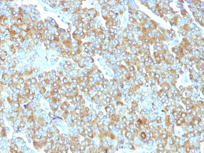 Formalin-fixed, paraffin-embedded human Small Cell Lung Carcinoma stained with Chromogranin A Monoclonal Antibody (PHE5)