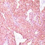 Formalin-fixed, paraffin-embedded human Small Cell Lung Carcinoma stained with Chromogranin A Monoclonal Antibody (SPM585)