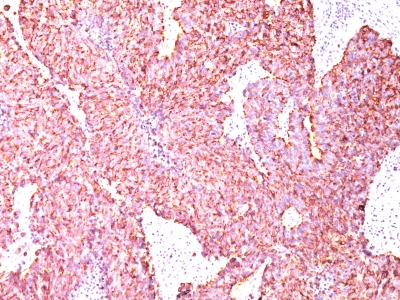 Formalin-fixed, paraffin-embedded human Small Cell Lung Carcinoma stained with Chromogranin A Monoclonal Antibody (SPM585)