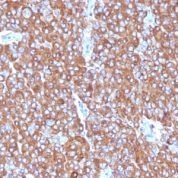 Formalin-paraffin human Small Cell Lung Carcinoma stained with Chromogranin A MAb (LK2H1+PHE5+CGA414)