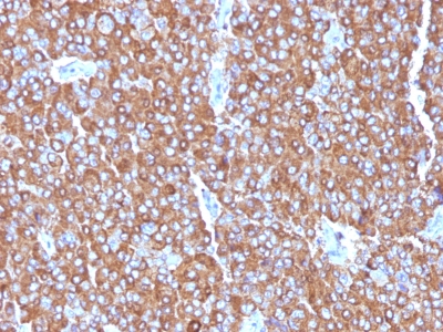 Formalin-paraffin human Small Cell Lung Carcinoma stained with Chromogranin A MAb (LK2H1+PHE5+CGA414)