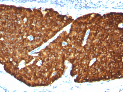 Formalin-fixed, paraffin-embedded human Parathyroid stained with Chromogranin A Monoclonal Antibody (CGA/413)