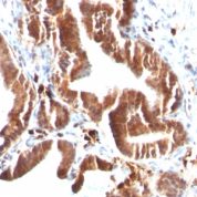 Formalin-fixed, paraffin-embedded human Melanoma stained with Topo I, MT Monoclonal Antibody (TOP1MT/488).