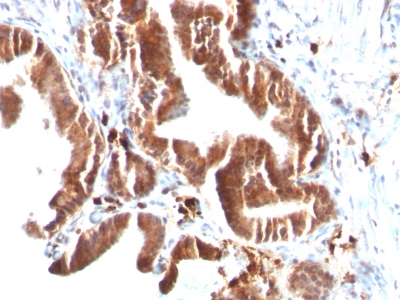 Formalin-fixed, paraffin-embedded human Melanoma stained with Topo I, MT Monoclonal Antibody (TOP1MT/488).