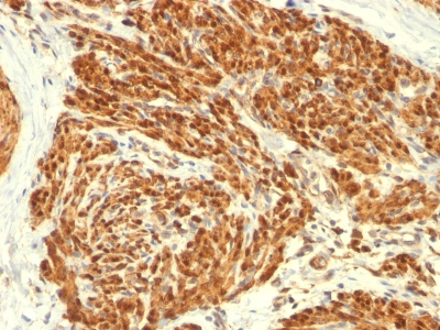 Formalin-fixed, paraffin-embedded human Uterus stained with Calponin-1 Monoclonal Antibody (CALP).