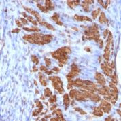 Formalin-fixed, paraffin-embedded human Breast Carcinoma stained with Calponin-1 Monoclonal Antibody (CNN1/832 + CALP).