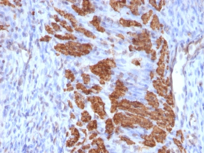 Formalin-fixed, paraffin-embedded human Breast Carcinoma stained with Calponin-1 Monoclonal Antibody (CNN1/832 + CALP).