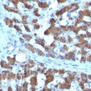 Formalin-fixed, paraffin-embedded human Hepatocellular Carcinoma stained with CPS1 Monoclonal Antibody (SPM615).