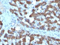 Formalin-fixed, paraffin-embedded human Hepatocellular Carcinoma stained with CPS1 Monoclonal Antibody (SPM615).