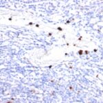 Formalin-fixed, paraffin-embedded human Tonsil stained with G-CSF Monoclonal Antibody (CSF3/9). Note specific cytoplasmic staining of granulocytes.