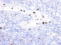 Formalin-fixed, paraffin-embedded human Tonsil stained with G-CSF Monoclonal Antibody (CSF3/9). Note specific cytoplasmic staining of granulocytes.