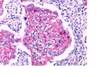 Formalin-paraffin breast lobular carcinoma stained with Beta Catenin (p12) PAb. Note cytoplasmic staining in lobular carcinoma.