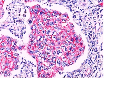 Formalin-paraffin breast lobular carcinoma stained with Beta Catenin (p12) PAb. Note cytoplasmic staining in lobular carcinoma.