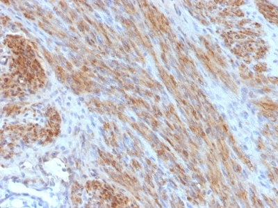 Formalin-fixed, paraffin-embedded human Uterus stained with Desmin Monoclonal Antibody (DES/1711)