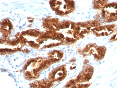 Formalin-fixed, paraffin-embedded human Ovarian Carcinoma stained with TAG-72 Monoclonal Antibody (B72.3).