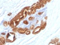 Formalin-fixed, paraffin-embedded human Ovarian Carcinoma stained with TAG-72 Monoclonal Antibody (CC49).