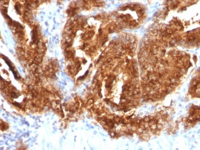 Formalin-fixed, paraffin-embedded human Ovarian Carcinoma stained with TAG-72 Monoclonal Antibody (CA72/733).