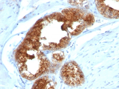 Formalin-fixed, paraffin-embedded human Ovarian Carcinoma stained with TAG-72 Monoclonal Antibody (B72.3 + CA72/733).