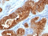 Formalin-fixed, paraffin-embedded human Ovarian Carcinoma stained with TAG-72 Monoclonal Antibody (B72.3 + CC49).