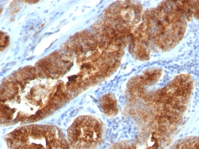 Formalin-fixed, paraffin-embedded human Ovarian Carcinoma stained with TAG-72 Monoclonal Antibody (B72.3 + CC49).
