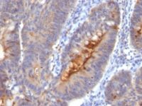 Formalin-fixed, paraffin-embedded human Colon Carcinoma stained with IgA Secretory Component Monoclonal Antibody (SC-5).