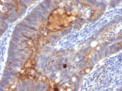 Formalin-fixed, paraffin-embedded human Colon Carcinoma stained with IgA Secretory Component Monoclonal Antibody (SPM217).