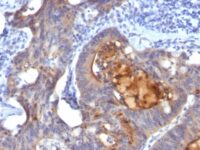 Formalin-fixed, paraffin-embedded human Colon Carcinoma stained with IgA Secretory Component Monoclonal Antibody (ECM1/792).