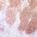 Formalin-fixed, paraffin-embedded human Lung SCC stained with EGFR Monoclonal Antibody (GFR/1667).