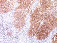 Formalin-fixed, paraffin-embedded human Lung SCC stained with EGFR Monoclonal Antibody (GFR/1667).