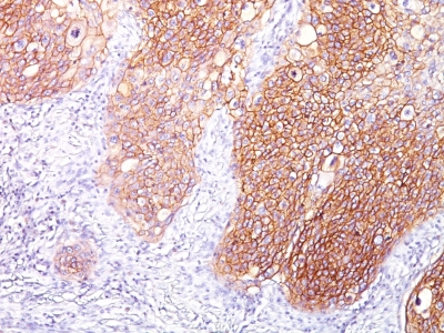 Formalin-fixed, paraffin-embedded human Lung SCC stained with EGFR Monoclonal Antibody (GFR/1667).