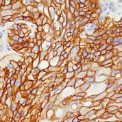 Formalin-fixed, paraffin-embedded human Lung SCC stained with EGFR Monoclonal Antibody (GFR/178).